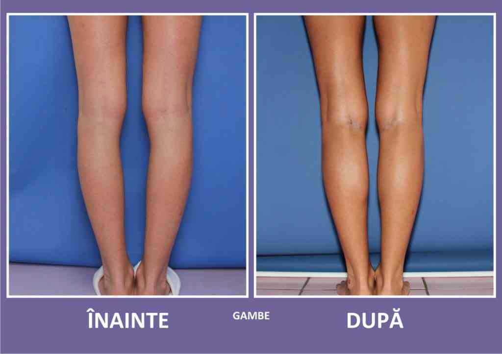 Implant de gambe vedere din spate