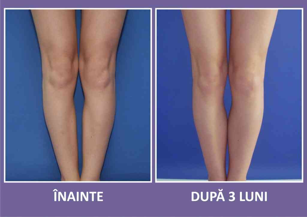 implant gambe caz 1 fata