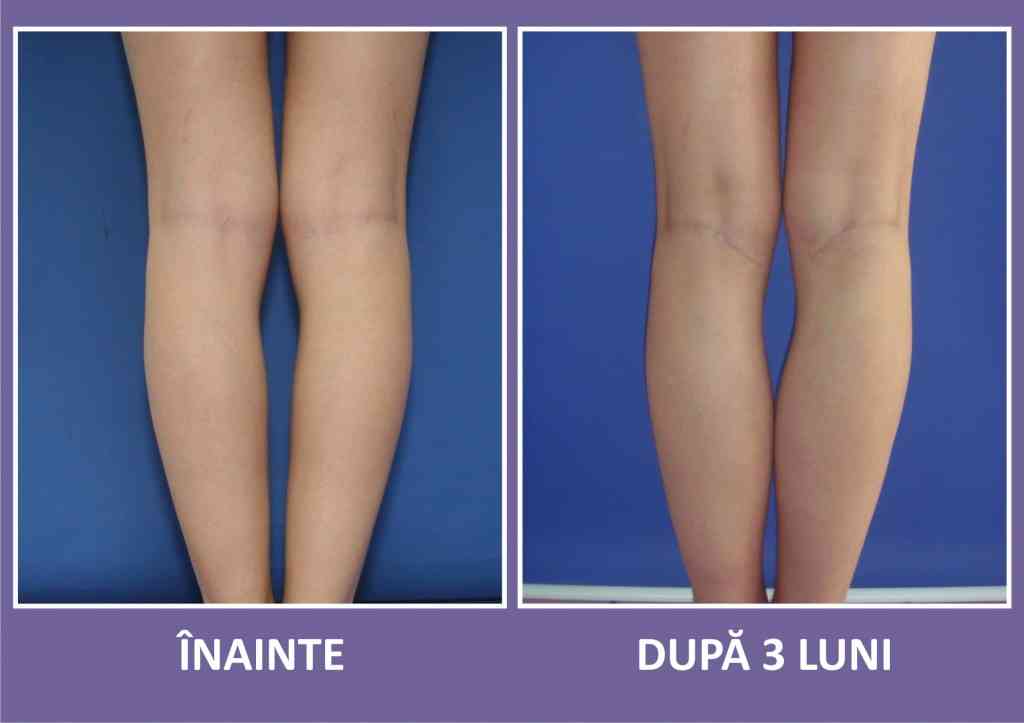 implant gambe caz 1 spate