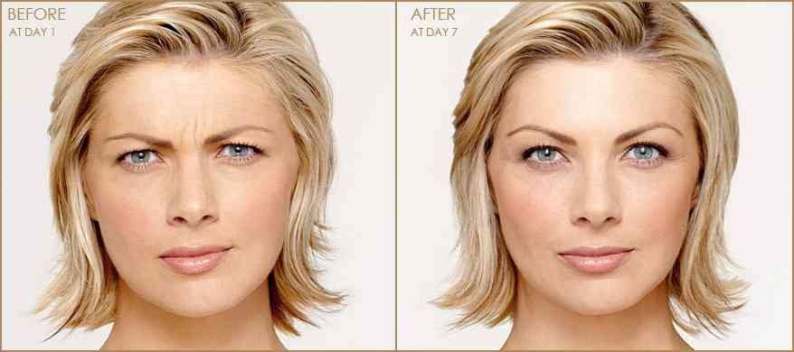 operatii estetice botox repede