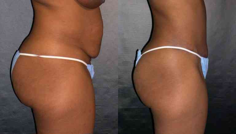 operatii estetice liposuctie