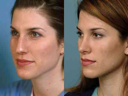 operatii estetice rinoplastie